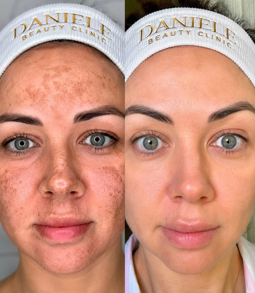 Antes e depois de peeling facial: redução de manchas e melasma