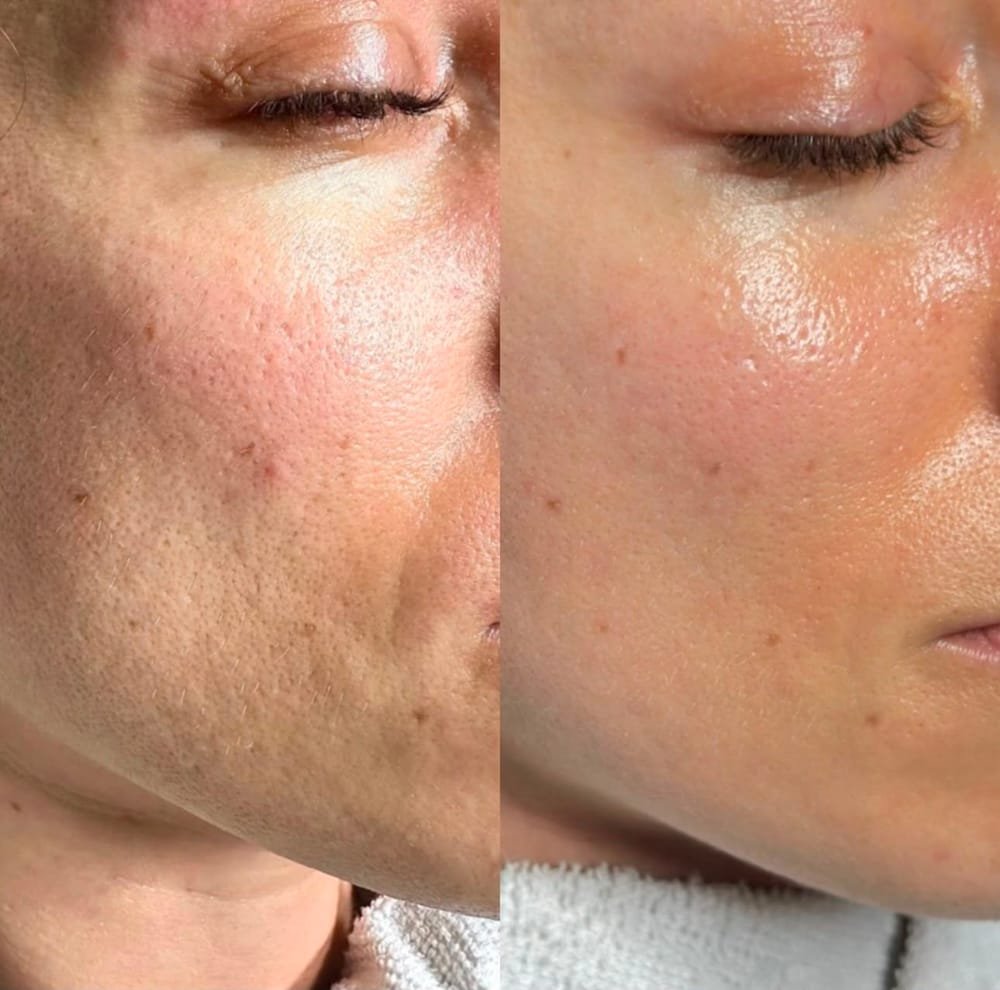 Antes e depois de microagulhamento facial: melhora de textura e poros