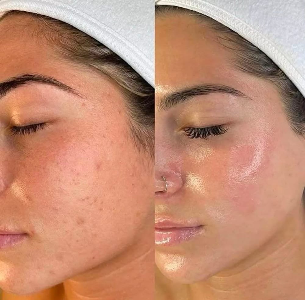 Antes e depois de microagulhamento: uniformidade e viço